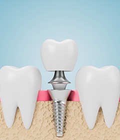 Illustration of dental implant, abutment, and crown