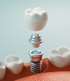 diagram showing the parts of a dental implant