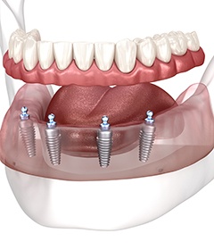 Illustration of four implants in lower arch anchoring full dentures