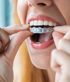 Close up of woman inserting Invisalign tray