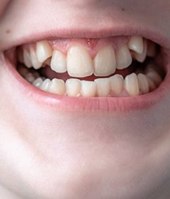 Close up of woman’s crooked teeth